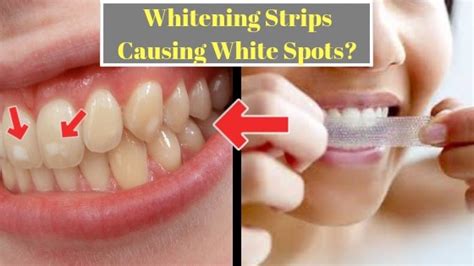 White Spots On Teeth Before And After