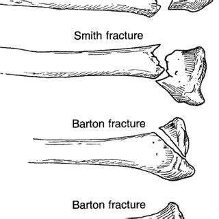 Smith Vs Colles Fracture