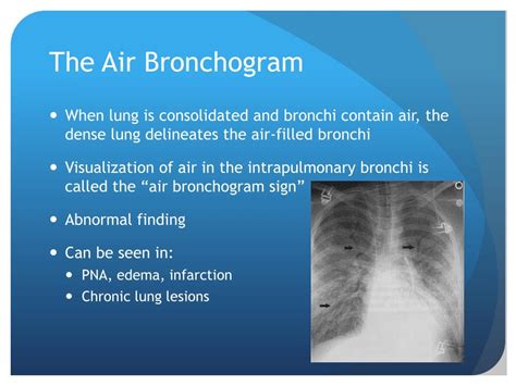 Ppt Chest X Ray Interpretation For The Internist Powerpoint Presentation Id 934924