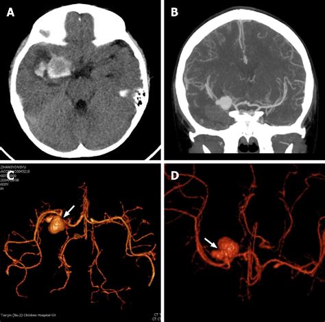 Figure 1 From Treatment Of Pediatric Intracranial Dissecting Aneurysm