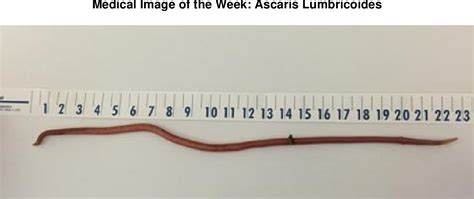 Figure 1 From Medical Image Of The Week Ascaris Lumbridoies Semantic Scholar