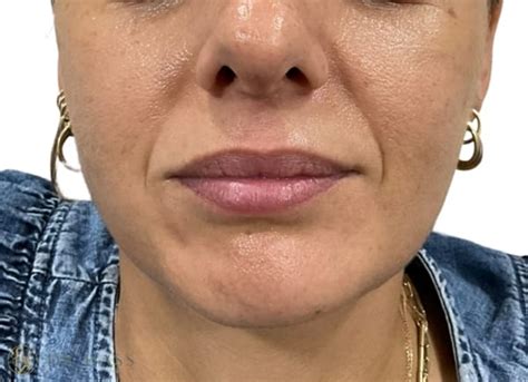 Best Lip Filler Treatment London Dr Hass Injectable Aesthetics