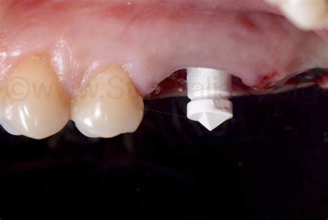 Sealing Socket Abutment A Novel Digitalized Strategy For Immediate