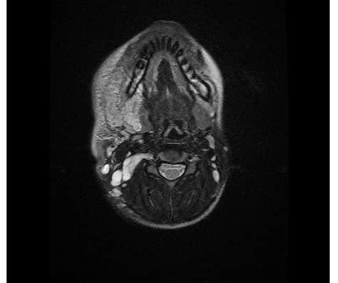 IRM Cervicale Coupe Axiale En S Quence Pond R E T2 Processus