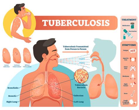 4 400 Tuberculose Stock Illustrations Graphiques Vectoriels Libre De