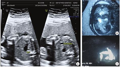 Successful Antenatal Diagnosis And Management Of A Rare Case Of Congenital Fetal Choledochal