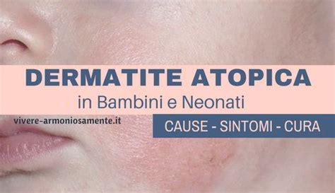 Dermatite Atopica Nei Bambini E Neonati Cause Sintomi E Cura