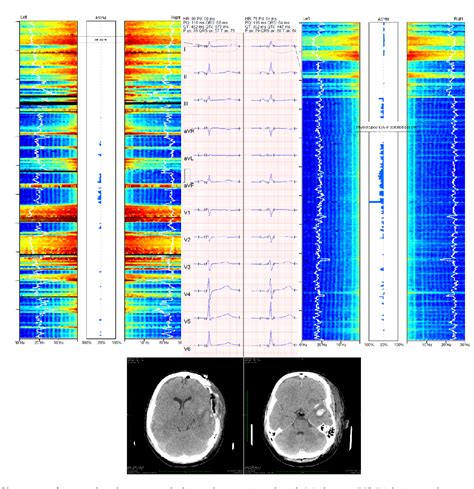 Figure 1 From Suppression Of Electrographic Seizures Is Associated With