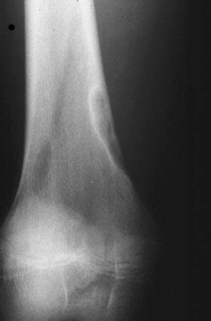 Nonossifying fibroma | BoneTumor.org