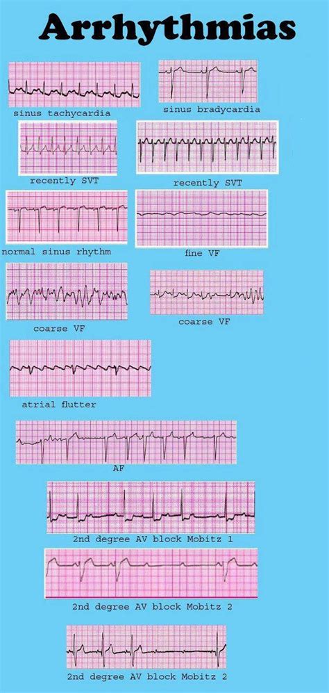 Ekg Interpretation Cheat Sheet Heart Arrhythmias Guide Update