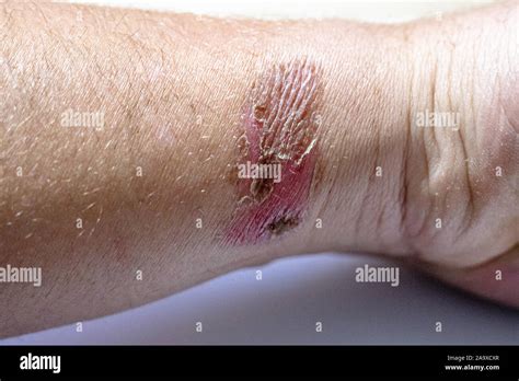 Badly Healed Burn On White Young Mans Wrist Stock Photo Alamy