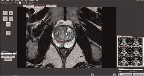 Figure 2 From The Role Of MRI TRUS Fusion Biopsy In The Diagnosis Of