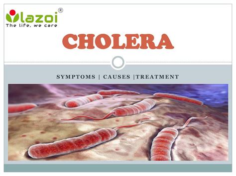 Ppt Cholera Symptoms Causes And Treatment Powerpoint Presentation Id7505051