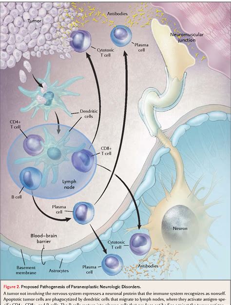 Figure From Mechanisms Of Disease Paraneoplastic Syndromes Involving