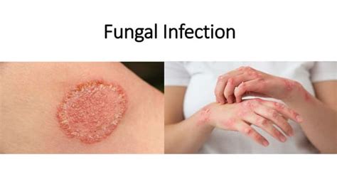 Fungal Infection (pharmacology and rehab) | PPT