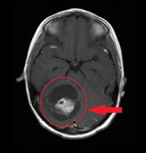 Astrocytoma MRI - wikidoc