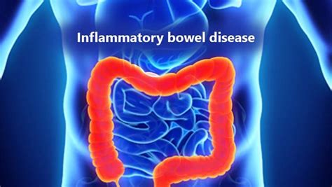 Inflammatory Bowel Disease and Unhealthy Diet Connection - MKExpress.net