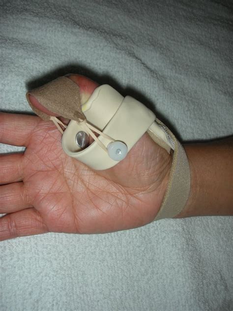 Dynamic Thumb Flexion Splint