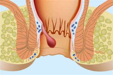 Genel Cerrahi Anal Fiss R Ve Anal Fist L Nedir Doktortakvimi