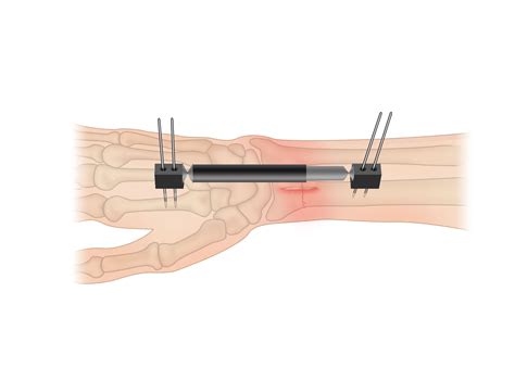 Distal Radius Fractures Broken Wrist Orthoinfo Aaos