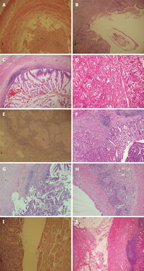 Unusual Histopathologic Findings A Appendix Vermiformis Showing