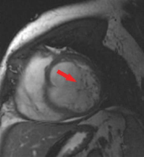 Cardiac Mri Short Axis View Shows Partial Thickness Of Free Wall Of The