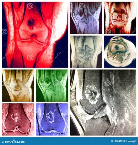 Knee Pathology Chondroid Lesion Enchondroma Mri Royalty-Free Stock ...