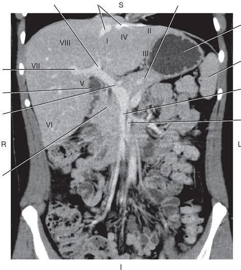 Diagram Of Coronal CT Reformat Of Liver Segments And Portal Vein Quizlet