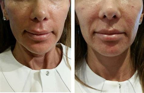 Vampire Facelift Before And After Photos (4) » Facelift: Info, Prices ...
