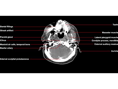 Ct Neck Axial Anatomy Radiologypicscom