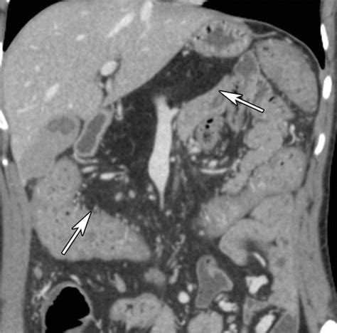 Pancreas In Hereditary Syndromes Cross Sectional Imaging Spectrum