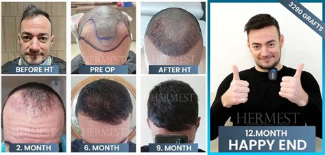 Norwood Hamilton Scale Understanding Hair Loss And Treatment Options