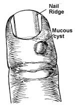 Mucous Cysts