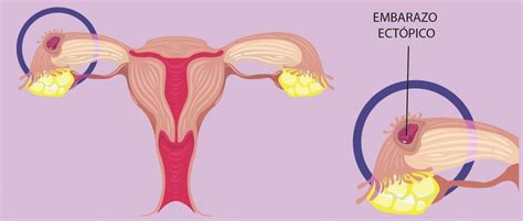 Embarazo ectópico Síntomas y tratamiento del embarazo extrauterino