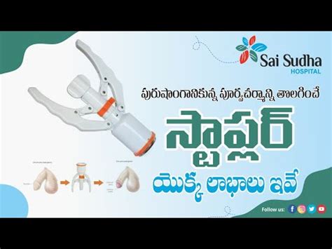 Painless Bloodless Stapler Circumcision సటపలర త లభల ఇవ