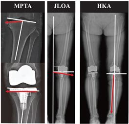 Coronal Alignment Of Three Different Types Of Implants In Kinematically