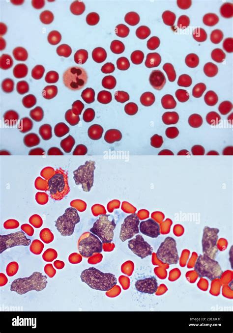 Leucemia Delle Cellule Umane Immagini E Fotografie Stock Ad Alta