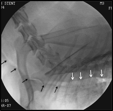 Advanced Tracheal Collapse