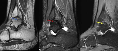 Imaging Features Of Avascular Necrosis Of The Foot And Ankle Foot And