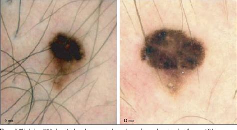 Figure 9 From Dermatoscopy Of Dysplastic Nevi A Beacon In Diagnostic