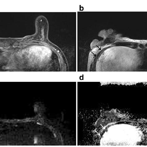 Multiple Pleural Metastases Pre Operative Breast Mri Of A Year Old