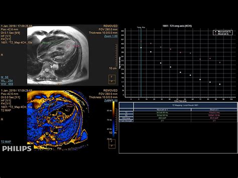 Myocardial Infarction With T1t2 Mapping Philips Mr Body Map