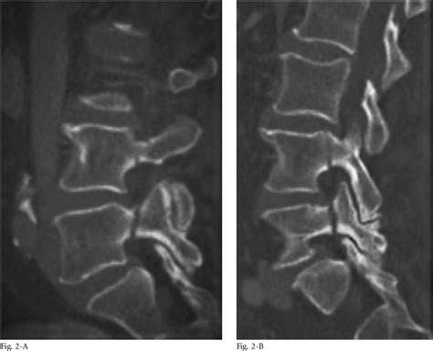 Figure 1 From Bilateral Pedicle Fractures At Contiguous Segments In A