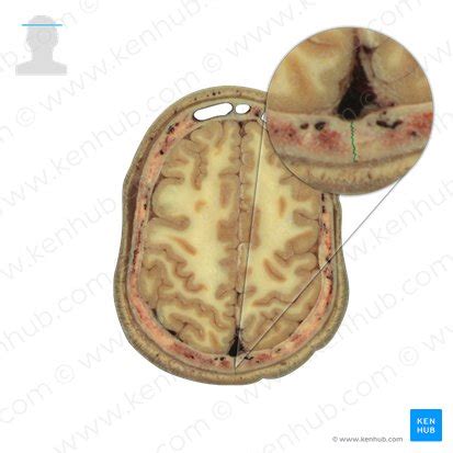 Sagittal suture: Anatomy and function | Kenhub