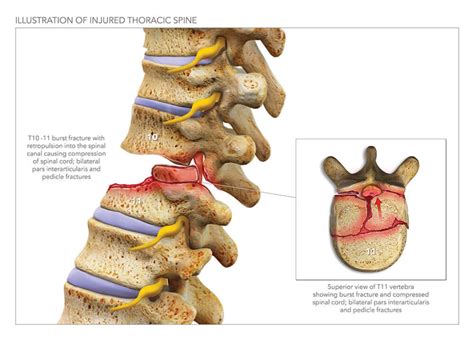 Thoracic Burst Fracture