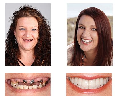 Fine Dentistry of Downtown Orlando | Implant Retained Dentures in Orlando