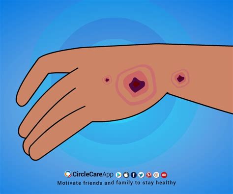 Symptom of Diabetes: Slow-healing sores or frequent infections | CircleCare