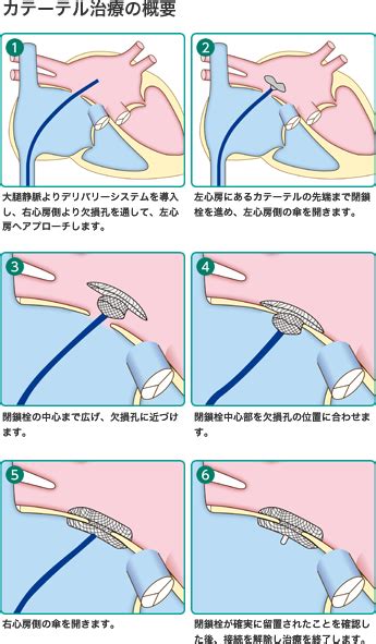 心房中隔欠損症に対するカテーテル治療を開始 診療の最前線 済生会熊本タイムズ 済生会熊本病院