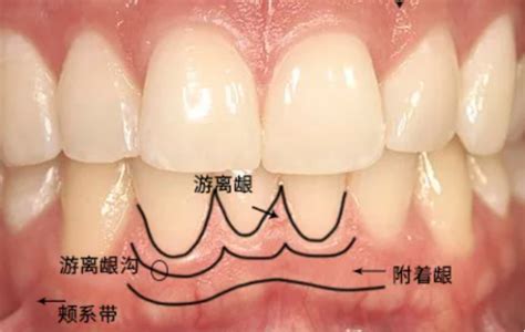 牙龈萎缩还有救吗？ 知乎