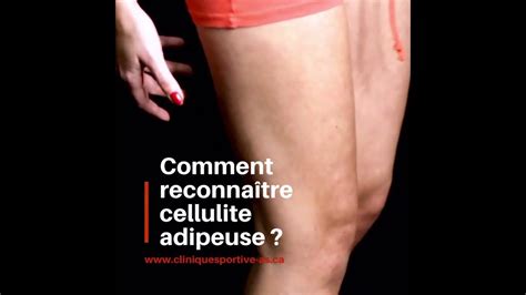 Comment Se Débarrasser Dune Cellulite Adipeuse Cliniquesportive As